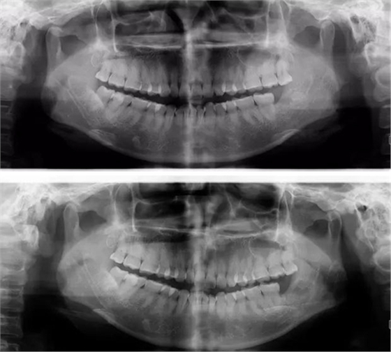 拔牙斷根的去與留？