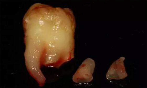 拔牙斷根的去與留？