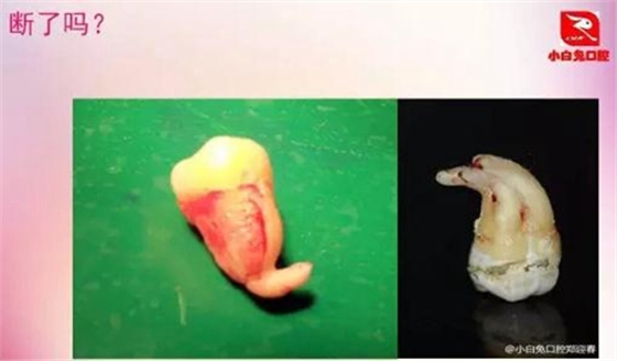 拔牙斷根的去與留？