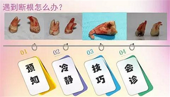 拔牙斷根的去與留？