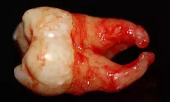 拔牙斷根的去與留？
