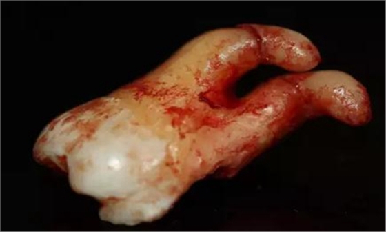 拔牙斷根的去與留？