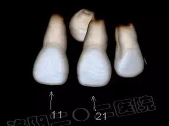 多生牙的拔除總原則：早發(fā)現(xiàn)，早處理！