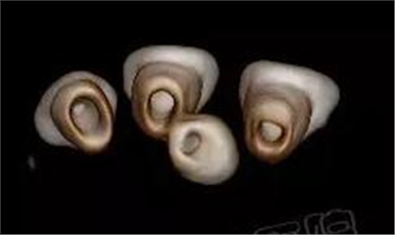 多生牙的拔除總原則：早發(fā)現(xiàn)，早處理！