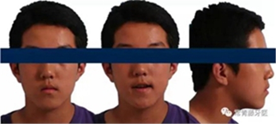 種植釘多維運(yùn)用矯正高角反頜及開頜&mdash;對(duì)羅晨醫(yī)生專訪及病例展示（上）