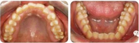 種植釘多維運(yùn)用矯正高角反頜及開頜&mdash;對(duì)羅晨醫(yī)生專訪及病例展示（上）