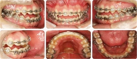 種植釘多維運(yùn)用矯正高角反頜及開頜&mdash;對(duì)羅晨醫(yī)生專訪及病例展示（上）
