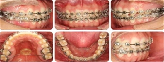 種植釘多維運(yùn)用矯正高角反頜及開頜&mdash;對(duì)羅晨醫(yī)生專訪及病例展示（上）