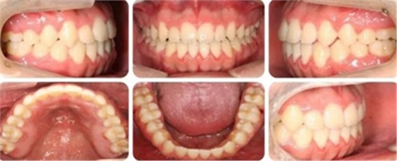 種植釘多維運(yùn)用矯正高角反頜及開頜&mdash;對(duì)羅晨醫(yī)生專訪及病例展示（上）