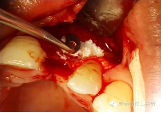 種植失敗的骨增量處理一例 