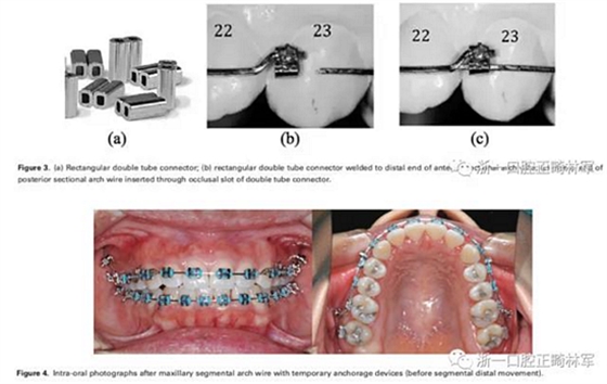 正畸文獻(xiàn)閱讀-兩種不同矯治力下上頜后牙段遠(yuǎn)移的生化與臨床比較 正畸文獻(xiàn)閱讀-兩種不同矯治力下上頜后牙段遠(yuǎn)移的生化與臨床比較