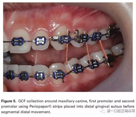 正畸文獻(xiàn)閱讀-兩種不同矯治力下上頜后牙段遠(yuǎn)移的生化與臨床比較 正畸文獻(xiàn)閱讀-兩種不同矯治力下上頜后牙段遠(yuǎn)移的生化與臨床比較