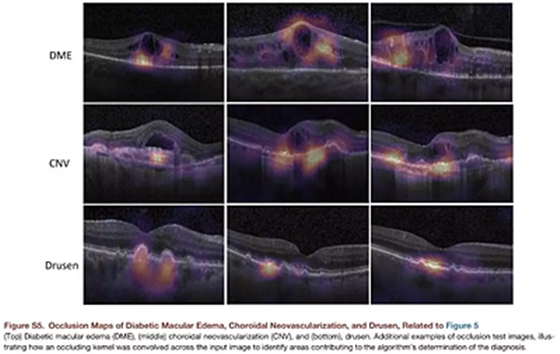 《細胞》重磅：中國科學家研發(fā)的AI影像診斷系統(tǒng)首登頂級期刊，可診斷眼病和肺炎兩大類疾病，準確性匹敵頂尖醫(yī)生 | 科學大發(fā)現(xiàn)