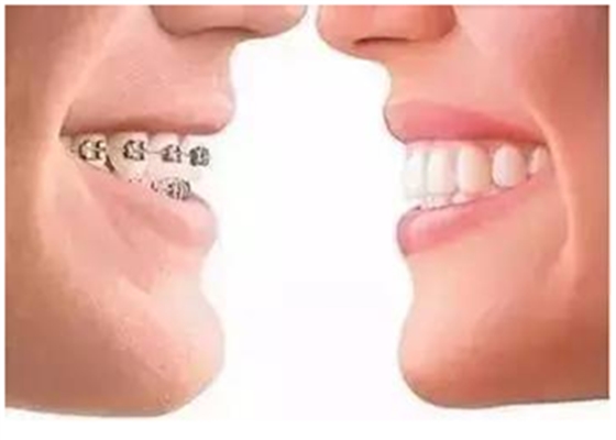 關(guān)于牙齒矯正，你想知道的都在這！
