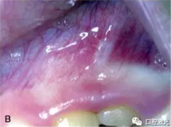 原創(chuàng) |利用半導(dǎo)體激光治療口腔潰瘍 原創(chuàng) |利用半導(dǎo)體激光治療口腔潰瘍