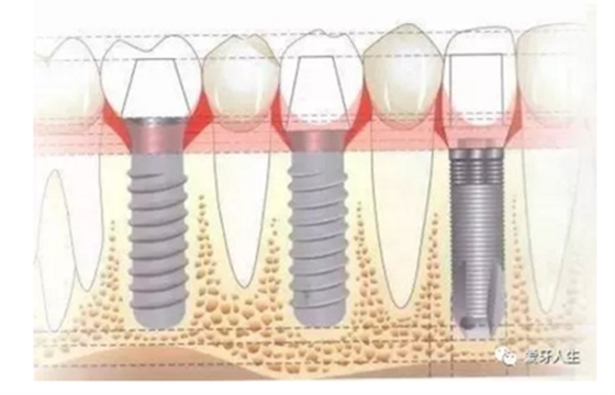 如何選擇種植牙，給《患者》推薦這篇文章就足矣