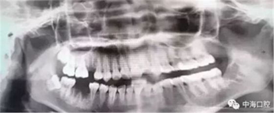 拔牙非小事，請不要拿成本衡量牙醫(yī)的價值！