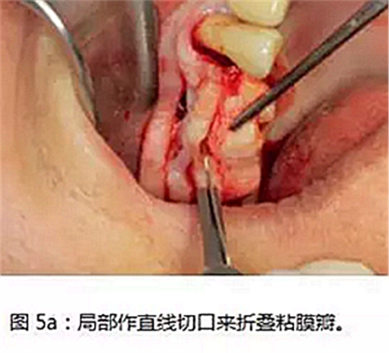 上頜竇瘺修補(bǔ)術(shù)——改良式旋轉(zhuǎn)帶蒂粘膜瓣修補(bǔ)術(shù)的應(yīng)用 上頜竇瘺修補(bǔ)術(shù)——改良式旋轉(zhuǎn)帶蒂粘膜瓣修補(bǔ)術(shù)的應(yīng)用