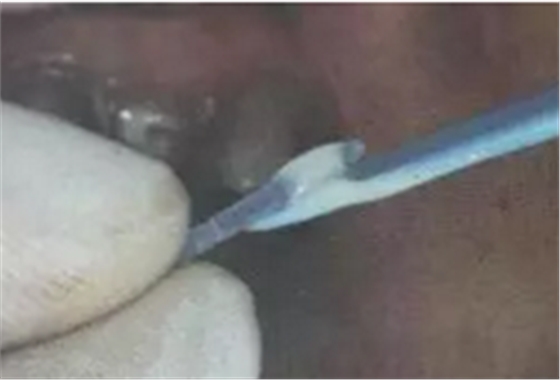 纖維樁修復(fù)之精細(xì)操作