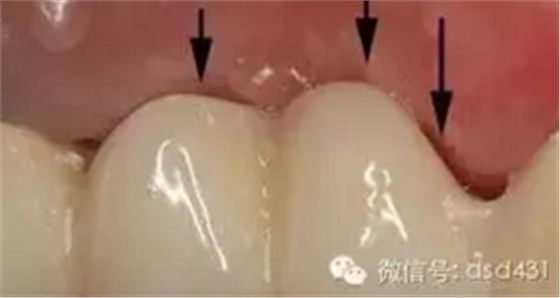 是什么導(dǎo)致了義齒返工？