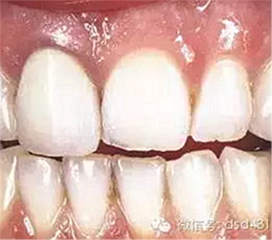 是什么導(dǎo)致了義齒返工？