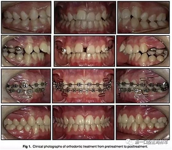 正畸文獻(xiàn)閱讀--正畸過(guò)程中牙根移動(dòng)的三維監(jiān)測(cè) 正畸文獻(xiàn)閱讀--正畸過(guò)程中牙根移動(dòng)的三維監(jiān)測(cè)