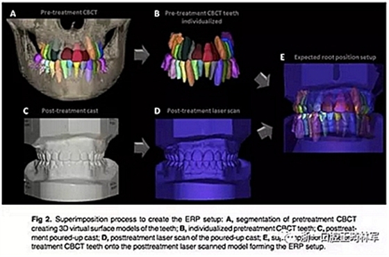 正畸文獻(xiàn)閱讀--正畸過(guò)程中牙根移動(dòng)的三維監(jiān)測(cè) 正畸文獻(xiàn)閱讀--正畸過(guò)程中牙根移動(dòng)的三維監(jiān)測(cè)