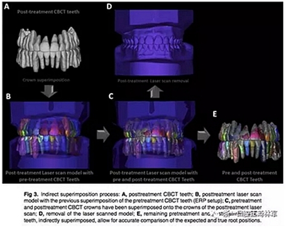 正畸文獻(xiàn)閱讀--正畸過(guò)程中牙根移動(dòng)的三維監(jiān)測(cè) 正畸文獻(xiàn)閱讀--正畸過(guò)程中牙根移動(dòng)的三維監(jiān)測(cè)