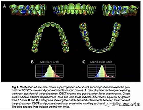 正畸文獻(xiàn)閱讀--正畸過(guò)程中牙根移動(dòng)的三維監(jiān)測(cè) 正畸文獻(xiàn)閱讀--正畸過(guò)程中牙根移動(dòng)的三維監(jiān)測(cè)