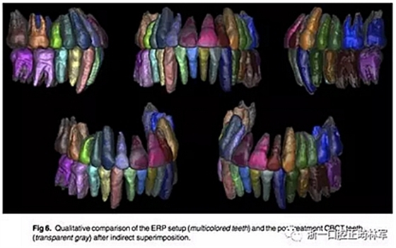 正畸文獻(xiàn)閱讀--正畸過(guò)程中牙根移動(dòng)的三維監(jiān)測(cè) 正畸文獻(xiàn)閱讀--正畸過(guò)程中牙根移動(dòng)的三維監(jiān)測(cè)