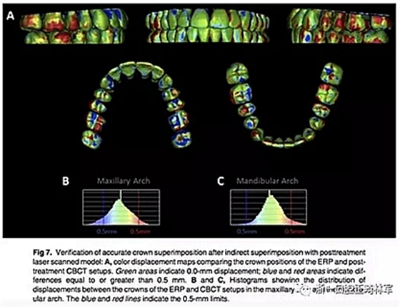 正畸文獻(xiàn)閱讀--正畸過(guò)程中牙根移動(dòng)的三維監(jiān)測(cè) 正畸文獻(xiàn)閱讀--正畸過(guò)程中牙根移動(dòng)的三維監(jiān)測(cè)