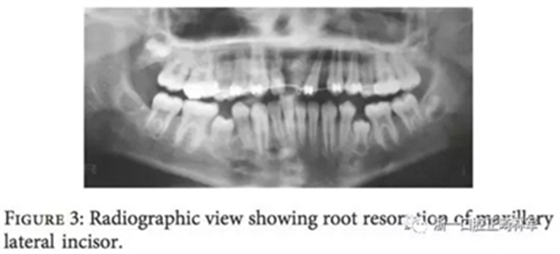 文獻(xiàn)優(yōu)秀正畸病例賞析--上頜中切牙區(qū)受傷后自體牙移植及正畸治療13年隨訪病例 文獻(xiàn)優(yōu)秀正畸病例賞析--上頜中切牙區(qū)受傷后自體牙移植及正畸治療13年隨訪病例