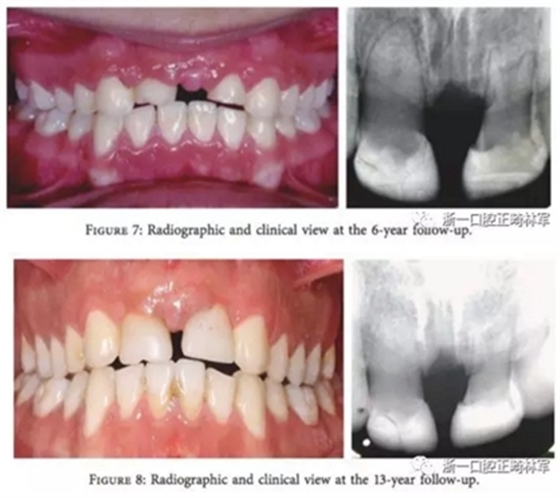 文獻(xiàn)優(yōu)秀正畸病例賞析--上頜中切牙區(qū)受傷后自體牙移植及正畸治療13年隨訪病例 文獻(xiàn)優(yōu)秀正畸病例賞析--上頜中切牙區(qū)受傷后自體牙移植及正畸治療13年隨訪病例