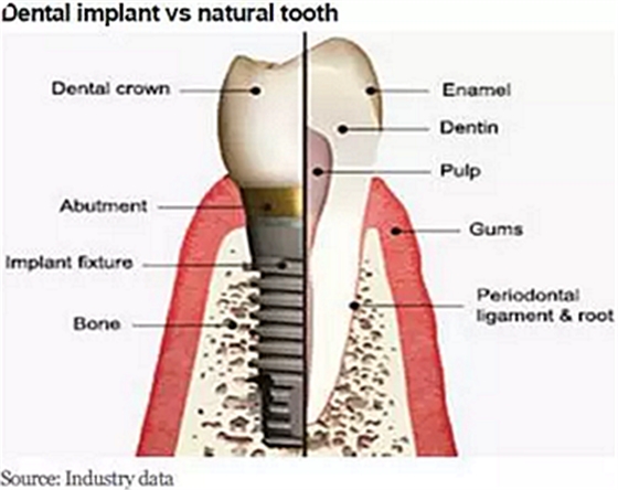 種植體，在全球牙科設(shè)備市場(chǎng)的變化！