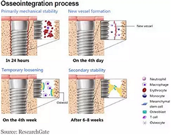 種植體，在全球牙科設(shè)備市場(chǎng)的變化！