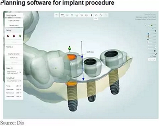 種植體，在全球牙科設(shè)備市場(chǎng)的變化！