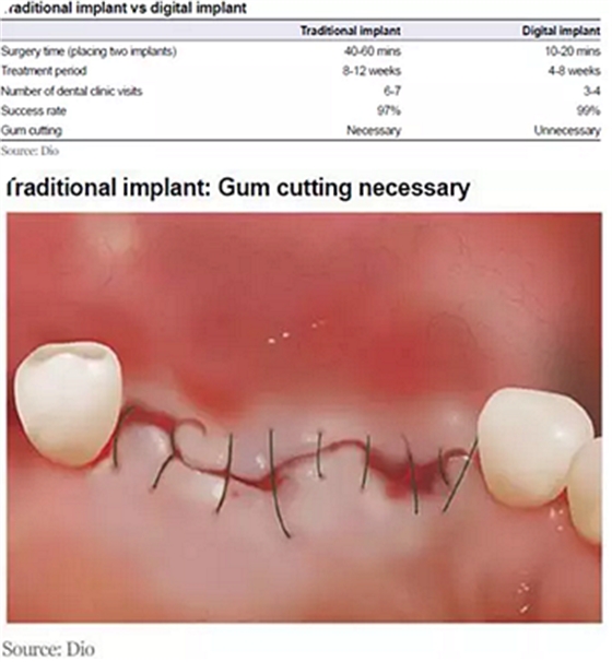 種植體，在全球牙科設(shè)備市場(chǎng)的變化！