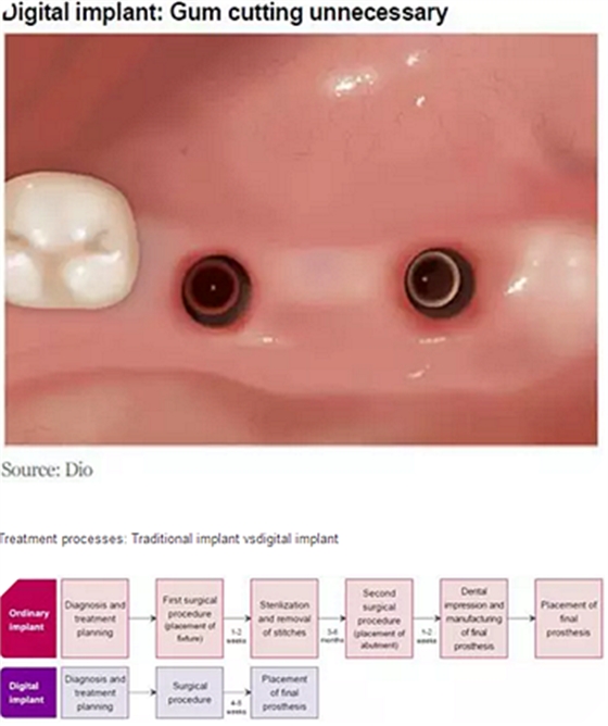 種植體，在全球牙科設(shè)備市場(chǎng)的變化！