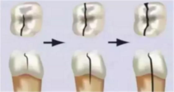 為什么有些牙齒不能拔？拔牙無(wú)小事！