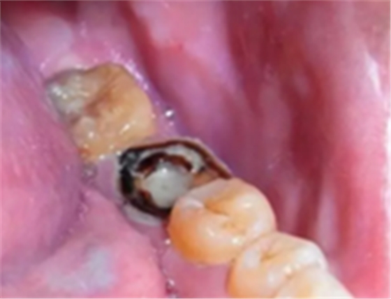 為什么有些牙齒不能拔？拔牙無(wú)小事！