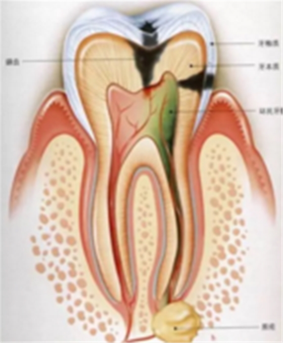 為什么有些牙齒不能拔？拔牙無(wú)小事！