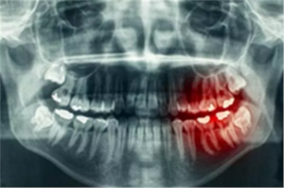 為什么有些牙齒不能拔？拔牙無(wú)小事！