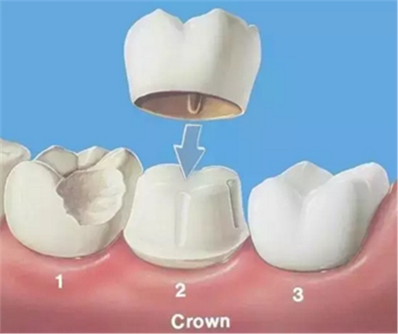 完全不懂，各種補(bǔ)牙材料，到底怎么選？