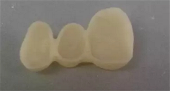 全鋯牙冠裂原因分析—操作流程工藝以及患者日常使用 全鋯牙冠裂原因分析—操作流程工藝以及患者日常使用