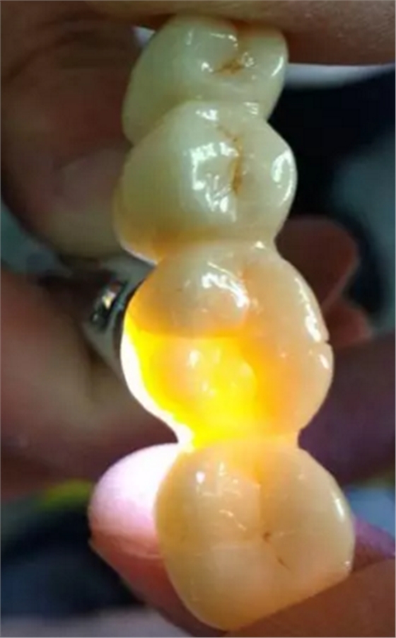 全鋯牙冠裂原因分析—操作流程工藝以及患者日常使用 全鋯牙冠裂原因分析—操作流程工藝以及患者日常使用