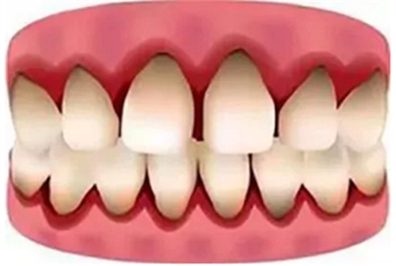 最可怕的牙病&mdash;&mdash;牙齦萎縮