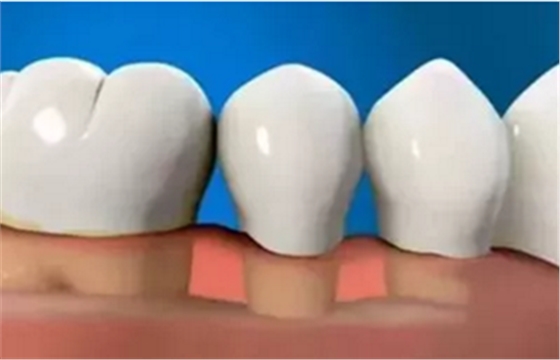 最可怕的牙病&mdash;&mdash;牙齦萎縮