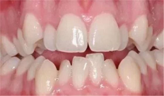 最可怕的牙病&mdash;&mdash;牙齦萎縮