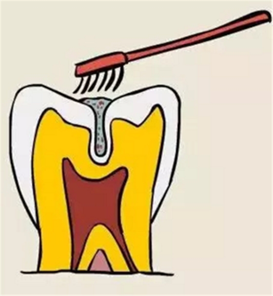 窩溝封閉 窩溝封閉