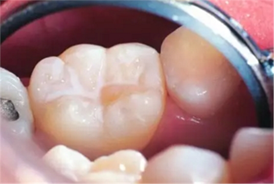 窩溝封閉 窩溝封閉